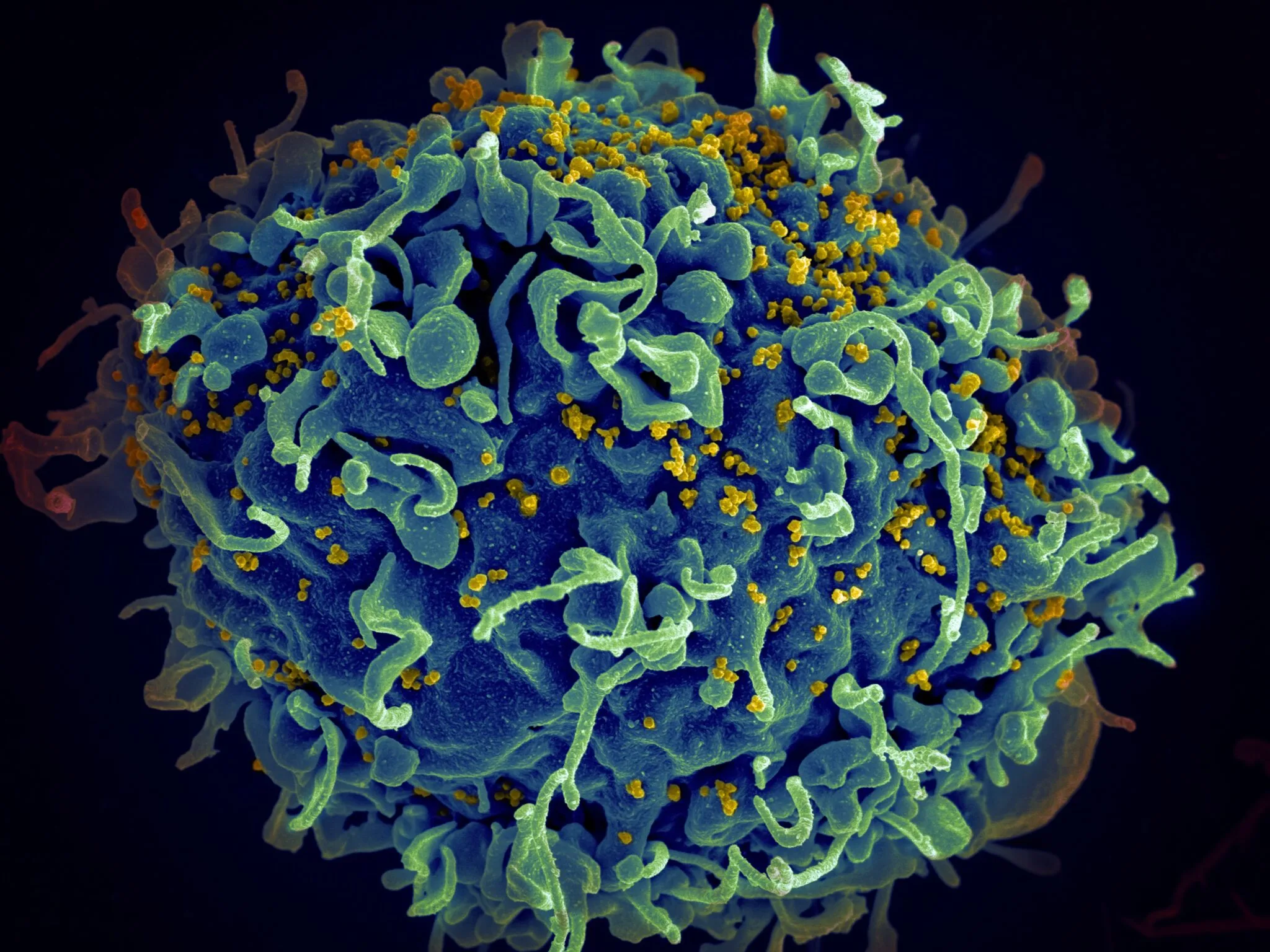A Fourth HIV Patient Appears To Have Been Cured