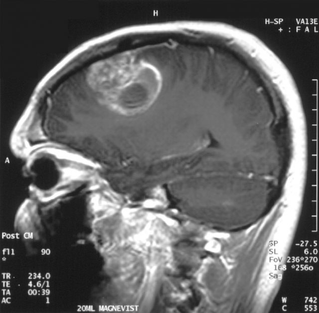 Glioblastoma example.