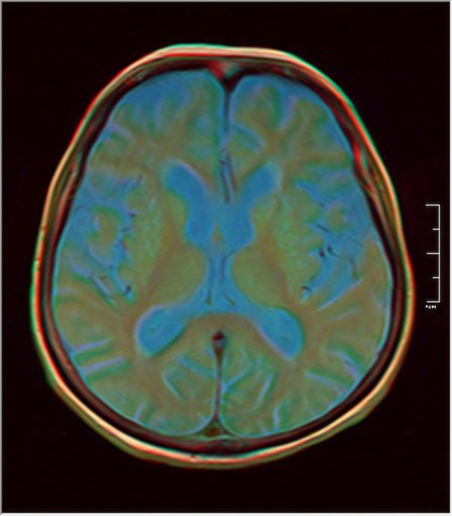 Army Vets’ Brain Scans Help Scientists Understand Trauma and Chronic Pain Management